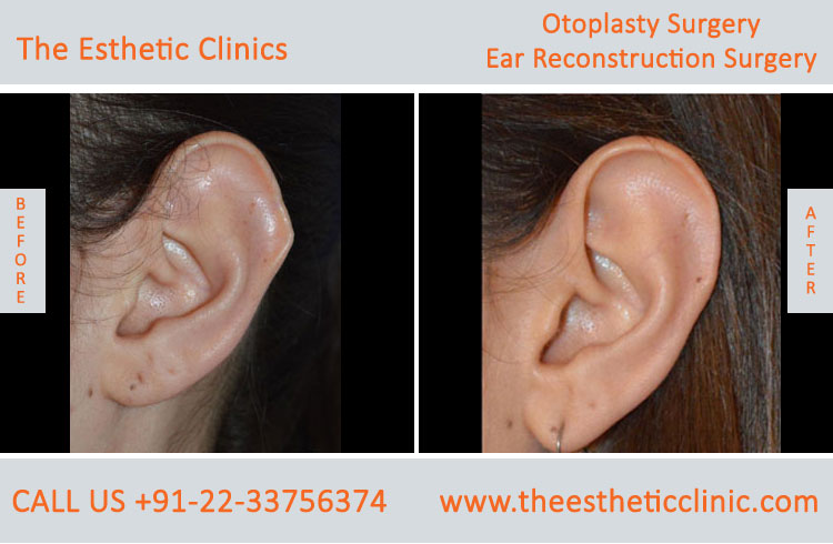 Otoplasty, Ear reconstruction surgery before after photos in mumbai india (2)